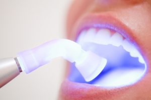 clareamento dental em curitiba