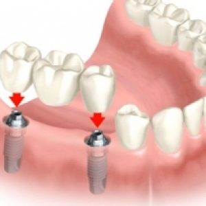 ilustração de uma boca mostrando os pinos implantados na gengiva