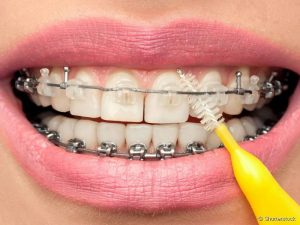 limpeza dental com aparelho ortodontico